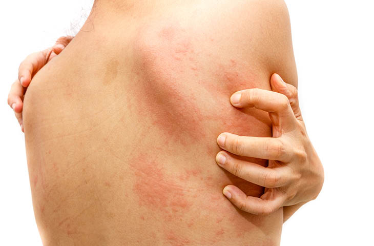 Dermatitis y alergia | Kern Pharma