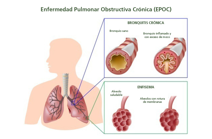 Enfermedad Pulmonar Obstructiva Crónica