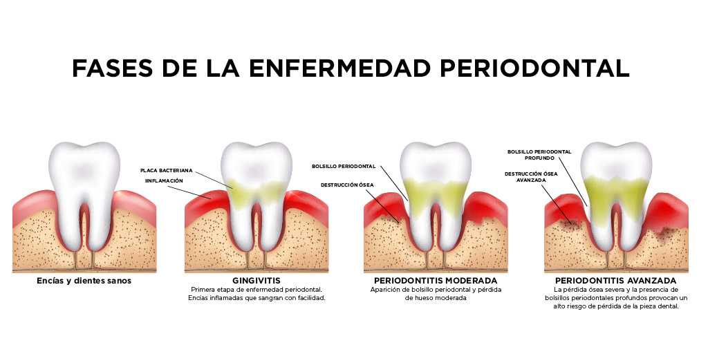 Fases de la periodontitis